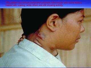 This patient has chronic peripheral lymphatic tuberculosis with some lesions healed with scaring, while others are still showing activity. 