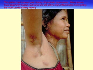 This patient had a seven-year history of lymphatic tuberculosis.  Many lesions have apparently healed, but some are still active (note inflammation surrounding the most caudal axillary lesion). 