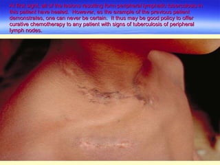 At first sight, all of the lesions resulting form peripheral lymphatic tuberculosis in this patient have healed.  However, as the example of the previous patient demonstrates, one can never be certain.  It thus may be good policy to offer curative chemotherapy to any patient with signs of tuberculosis of peripheral lymph nodes. 
