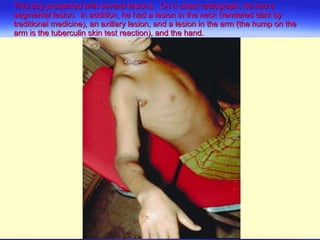 This boy presented with several lesions.  On a chest radiograph, he had a segmental lesion.  In addition, he had a lesion in the neck (rendered dark by traditional medicine), an axillary lesion, and a lesion in the arm (the hump on the arm is the tuberculin skin test reaction), and the hand.  