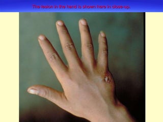 The lesion in the hand is shown here in close-up. 