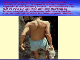 This patient with tuberculosis of the spine and a visible abscess, slightly discoloring the overlaying skin, on the lower left back almost escaped a correct diagnosis but for an astute laboratory technician.  The abscess was warm to the touch and a Gram stain showed Gram-positive cocci.  Nevertheless, the  laboratory technician insisted on rigorous examination for acid-fast bacilli and found them, confirming tuberculosis of the spine with a super-infected abscess. 