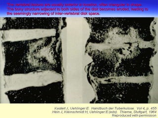 The vertebral lesions are usually anterior in location, often triangular in shape.  The bony structure adjacent to both sides of the disk becomes eroded, leading to the seemingly narrowing of inter-vertebral disk space.  