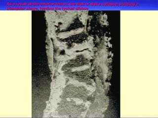 As a result of the anterior lesion, the disk or disks collapse, building a triangular shape, leading the typical gibbus  