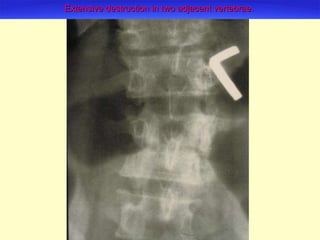 Extensive destruction in two adjacent vertebrae.   