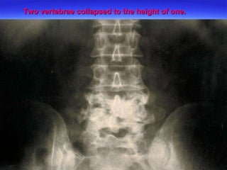 Two vertebrae collapsed to the height of one.   