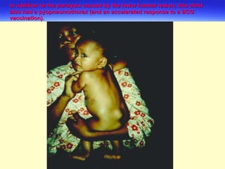 In addition to the paralysis caused by the lower lumbar lesion, this child also had a pyopneumothorax (and an accelerated response to a BCG vaccination). 