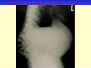 This patient has a severe gibbus in the lower thoracic region.   