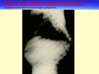 This patient with a 90 degree lesion in the spine was ambulatory when interviewed.  He had had received a full course of anti-tuberculosis treatment and had no neurologic symptoms. 