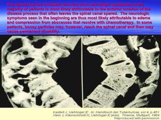 The reason for the complete recovery from neurologic symptoms in the majority of patients is most likely attributable to the anterior location of the disease process that often leaves the spinal canal spared.  The neurologic symptoms seen in the beginning are thus most likely attributable to edema and compression from abscesses that resolve with chemotherapy.  In some patients, boney particles may, however, reach the spinal canal and then may cause permanent disability.  