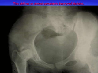 This girl had an almost completely destroyed hip joint. 