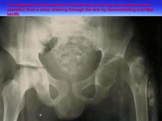The diagnosis of tuberculosis of the left hip in this boy was made from the secretion from a sinus draining through the skin by demonstrating acid-fast bacilli.  