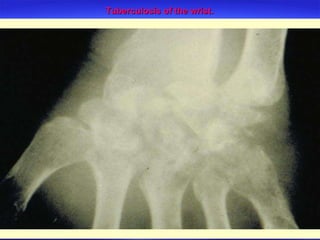 Tuberculosis of the wrist. 
