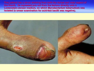 This patient has a sinus draining from both the dorsal and volar aspect of the thumb.  He squeezed pus out from the lesions directly onto a Lowenstein-Jensen medium, on which  Mycobacterium tuberculosis  was isolated (a smear examination for acid-fast bacilli was negative).  