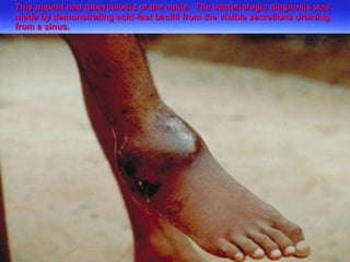 This patient had tuberculosis of the ankle.  The bacteriologic diagnosis was made by demonstrating acid-fast bacilli from the visible secretions draining from a sinus. 