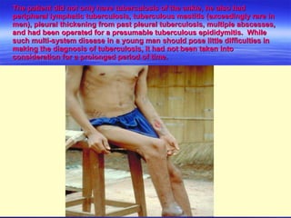 The patient did not only have tuberculosis of the ankle, he also had peripheral lymphatic tuberculosis, tuberculous mastitis (exceedingly rare in men), pleural thickening from past pleural tuberculosis, multiple abscesses, and had been operated for a presumable tuberculous epididymitis.  While such multi-system disease in a young man should pose little difficulties in making the diagnosis of tuberculosis, it had not been taken into consideration for a prolonged period of time. 
