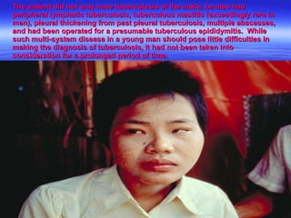 The patient did not only have tuberculosis of the ankle, he also had peripheral lymphatic tuberculosis, tuberculous mastitis (exceedingly rare in men), pleural thickening from past pleural tuberculosis, multiple abscesses, and had been operated for a presumable tuberculous epididymitis.  While such multi-system disease in a young man should pose little difficulties in making the diagnosis of tuberculosis, it had not been taken into consideration for a prolonged period of time. 