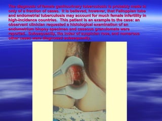 The diagnosis of female genitourinary tuberculosis is probably made in only of a fraction of cases.  It is believed, however, that Falloppian tube and endometrial tuberculosis may account for much female infertility in high-incidence countries.  This patient is an example to the case: an observant clinician requested a histological examination of an endometrium biopsy specimen and caseous granulomata were reported.  Subsequently, the index of suspician rose, and numerous other cases were diagnosed subsequently. 