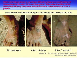 Warty skin tuberculosis is a perhaps difficult to diagnose manifestation of tuberculosis of the skin if it is not thought of.  This patient testifies to the remarkable efficacy of modern anti-tuberculosis chemotherapy in such a patient.  