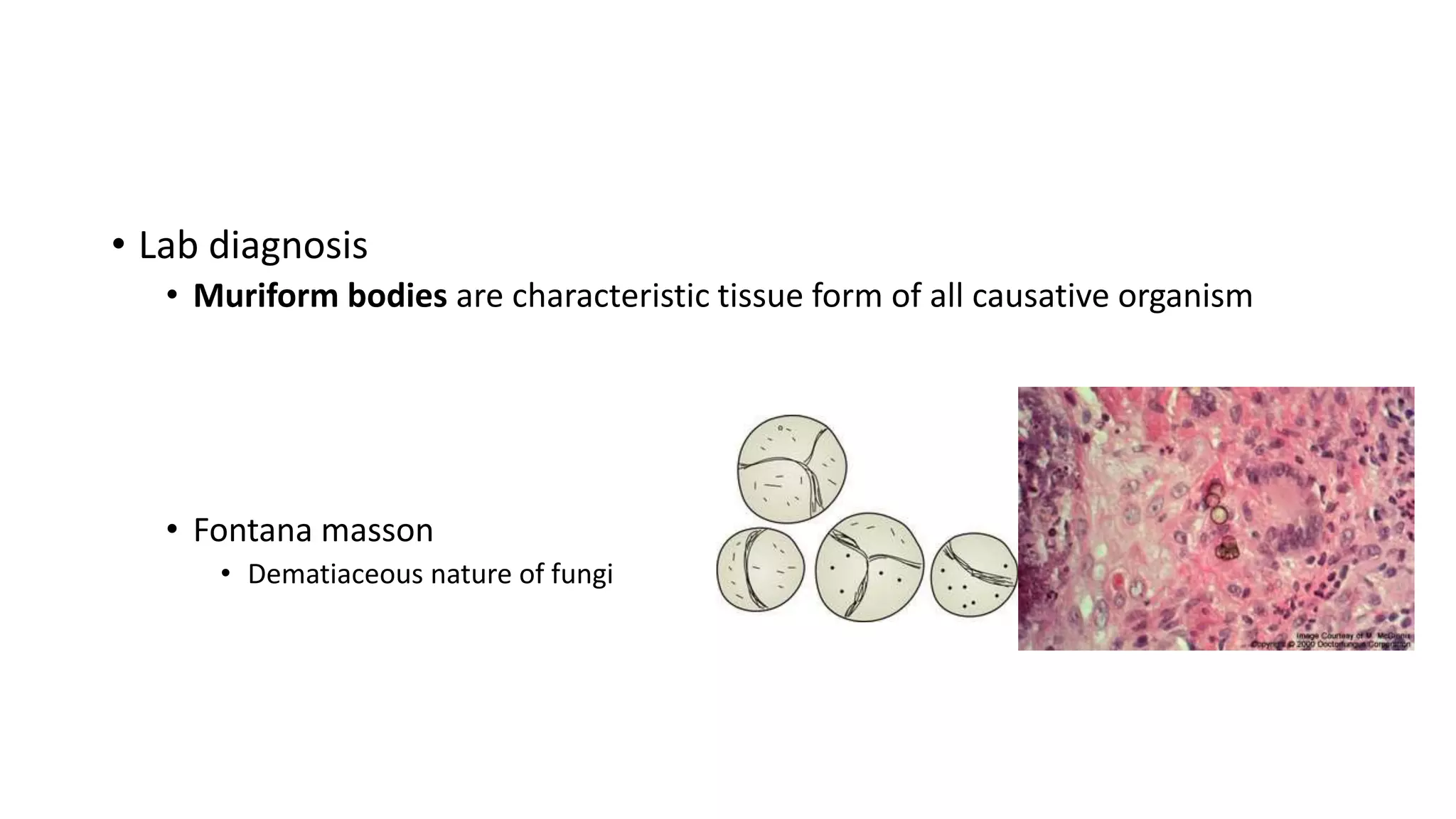 • Lab diagnosis
• Muriform bodies are characteristic tissue form of all causative organism
• Fontana masson
• Dematiaceous nature of fungi
 