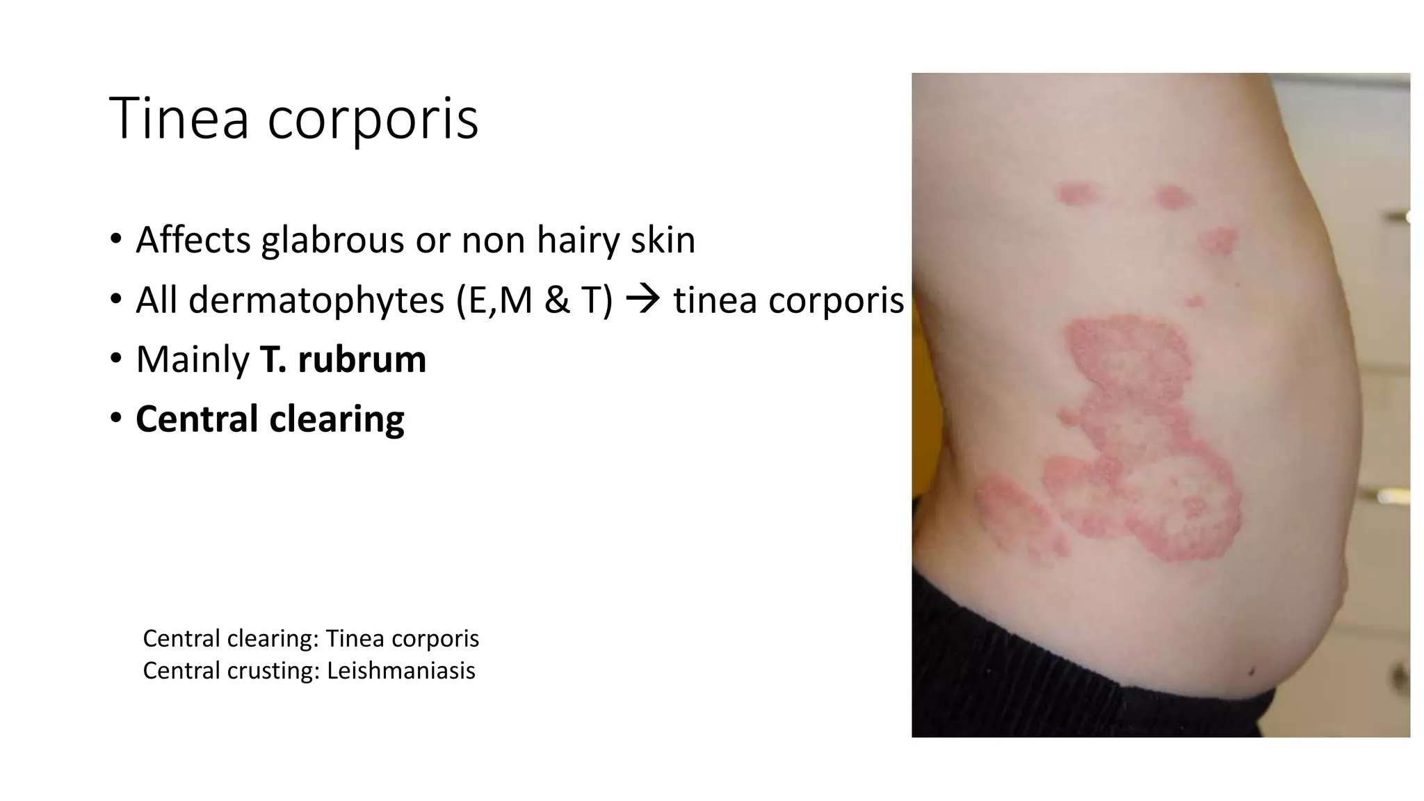 Tinea corporis
• Affects glabrous or non hairy skin
• All dermatophytes (E,M & T)  tinea corporis
• Mainly T. rubrum
• Central clearing
Central clearing: Tinea corporis
Central crusting: Leishmaniasis
 