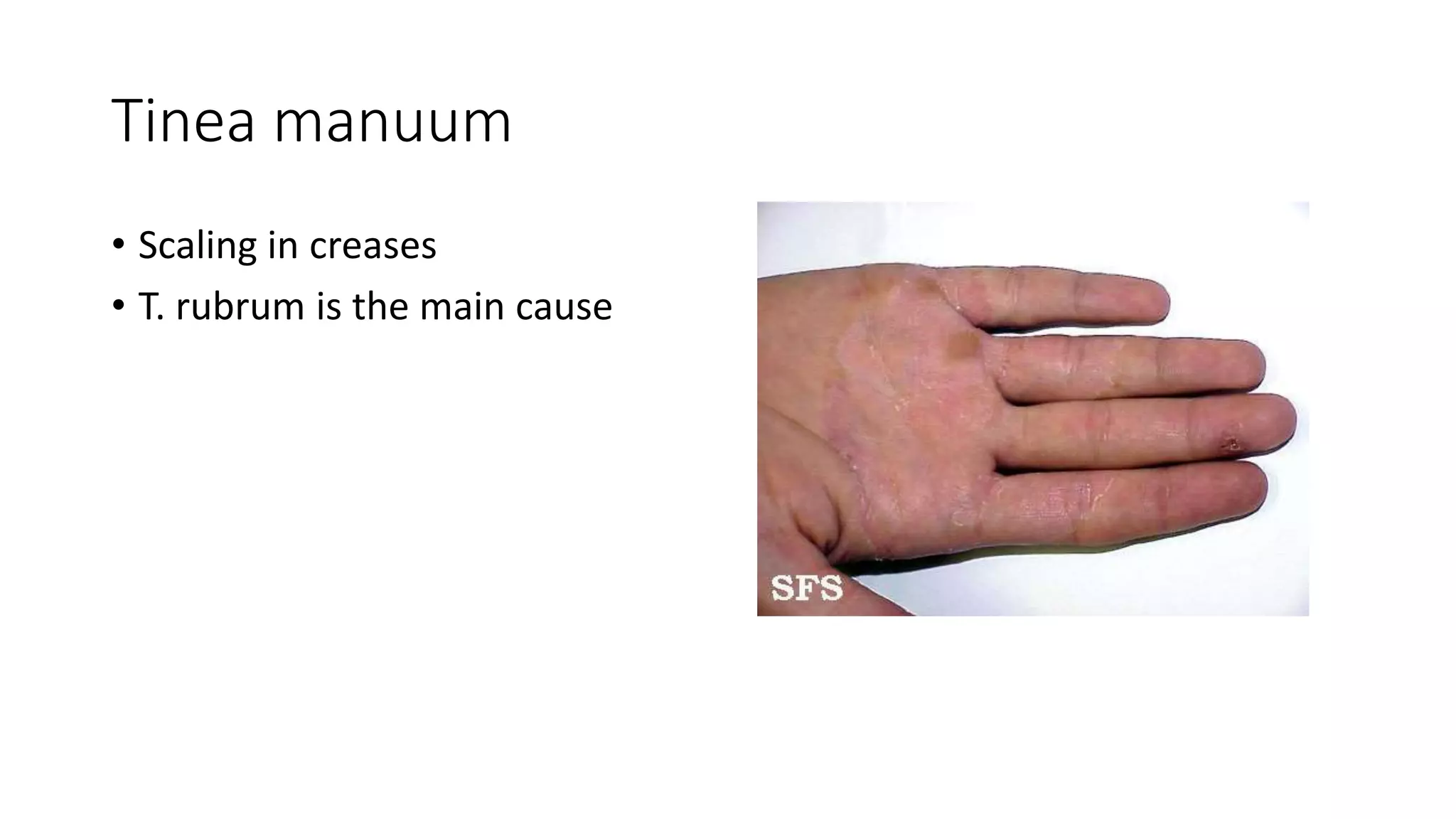 Tinea manuum
• Scaling in creases
• T. rubrum is the main cause
 