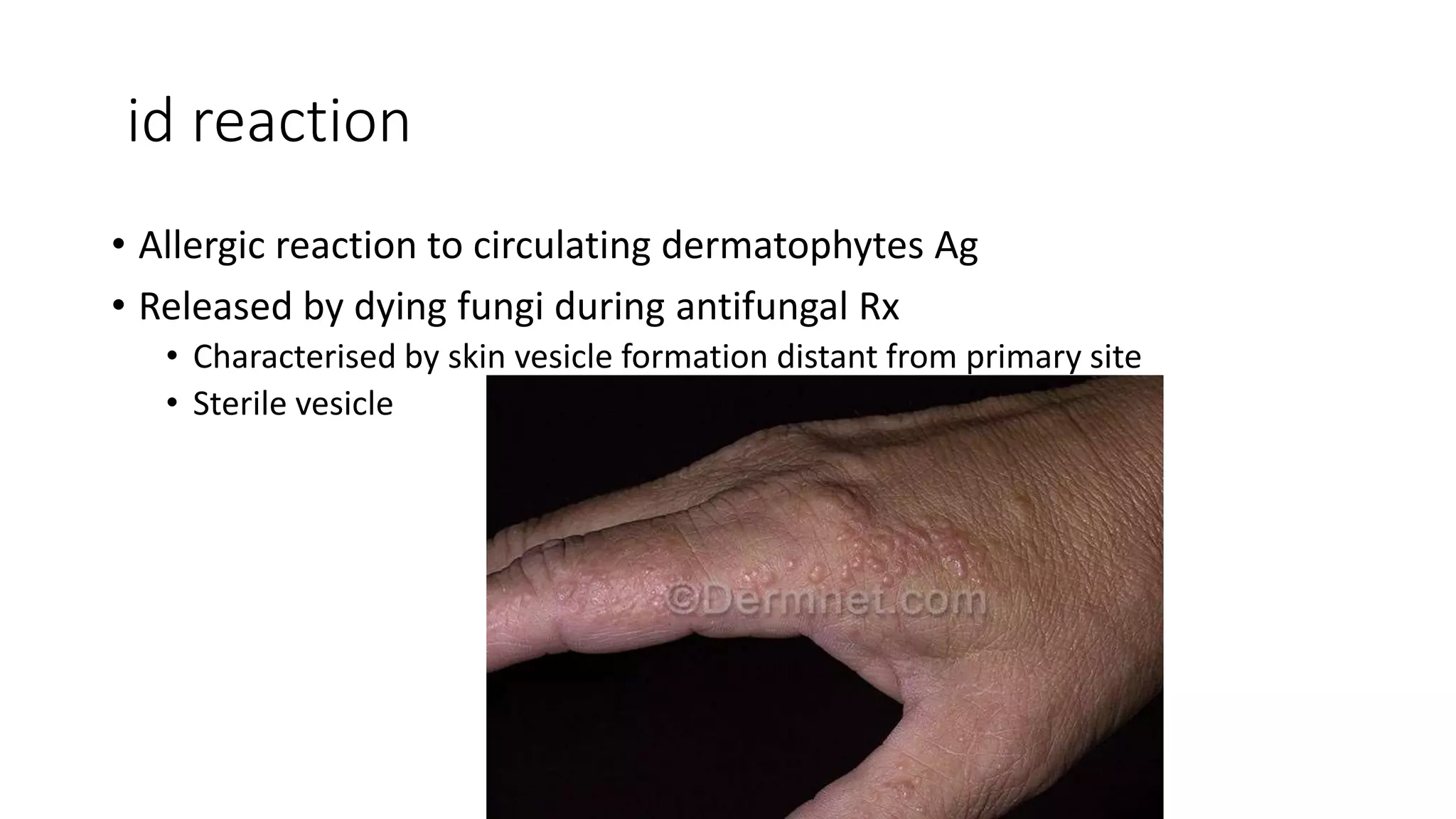 id reaction
• Allergic reaction to circulating dermatophytes Ag
• Released by dying fungi during antifungal Rx
• Characterised by skin vesicle formation distant from primary site
• Sterile vesicle
 