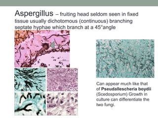 Aspergillus – fruiting head seldom seen in fixed
tissue usually dichotomous (continuous) branching
septate hyphae which branch at a 45°angle
Can appear much like that
of Pseudallescheria boydii
(Scedosporium) Growth in
culture can differentiate the
two fungi.
 