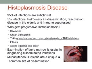 Histoplasmosis Disease
• 95% of infections are subclinical
• 5% infections: Pulmonary +/- dissemination, reactivation
disease in the elderly and immune suppressed
• Who gets progressive Histoplasmosis?
• HIV/AIDS
• Organ transplants
• Taking medications such as corticosteroids or TNF-inhibitors
• Infants
• Adults aged 55 and older
• Examination of bone marrow is useful in
diagnosing disseminated infections
• Mucocutaneous lesions are a unique &
common site of dissemination
 