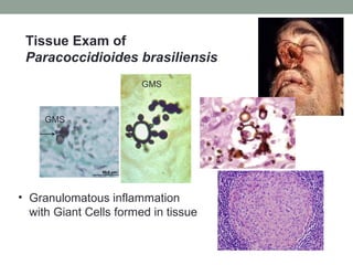 Tissue Exam of
Paracoccidioides brasiliensis
• Granulomatous inflammation
with Giant Cells formed in tissue
GMS
GMS
 