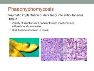 Phaeohyphomycosis
Traumatic implantation of dark fungi into subcutaneous
tissue
• Variety of infections but nodular lesions most common
with/without dissemination
• Dark hyphae observed in tissue
 