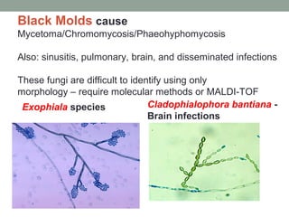 Exophiala species
Black Molds cause
Mycetoma/Chromomycosis/Phaeohyphomycosis
Also: sinusitis, pulmonary, brain, and disseminated infections
These fungi are difficult to identify using only
morphology – require molecular methods or MALDI-TOF
Cladophialophora bantiana -
Brain infections
 