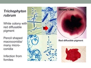 Trichophyton
rubrum
White colony with
red diffusable
pigment
Pencil shaped
macroconidia/
many micro-
conidia
Infection from
fomites
Red diffusible pigment
 