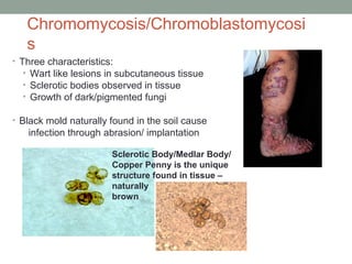 Chromomycosis/Chromoblastomycosi
s
• Three characteristics:
• Wart like lesions in subcutaneous tissue
• Sclerotic bodies ...