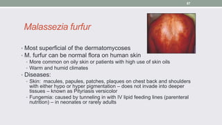 Malassezia furfur
• Most superficial of the dermatomycoses
• M. furfur can be normal flora on human skin
• More common on ...
