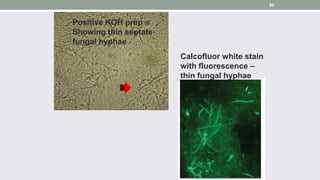 Positive KOH prep
Showing thin septate
fungal hyphae
Calcofluor white stain
with fluorescence –
thin fungal hyphae
90
 