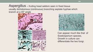 Aspergillus – fruiting head seldom seen in fixed tissue
usually dichotomous (continuous) branching septate hyphae which
branch at a 45* angle
Can appear much like that of
Scedosporium species,
Growth in culture can
differentiate the two fungi.
104
 