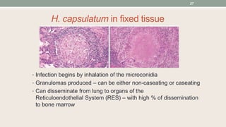 H. capsulatum in fixed tissue
• Infection begins by inhalation of the microconidia
• Granulomas produced – can be either non-caseating or caseating
• Can disseminate from lung to organs of the
Reticuloendothelial System (RES) – with high % of dissemination
to bone marrow
27
 