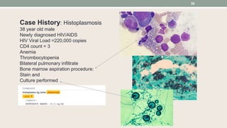 Case History: Histoplasmosis
38 year old male
Newly diagnosed HIV/AIDS
HIV Viral Load =220,000 copies
CD4 count = 3
Anemia
Thrombocytopenia
Bilateral pulmonary infiltrate
Bone marrow aspiration procedure:
Stain and
Culture performed
30
 
