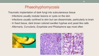 Phaeohyphomycosis
Traumatic implantation of dark fungi into subcutaneous tissue
• Infections usually nodular lesions or cy...
