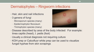 Dermatophytes – Ringworm infections
• Hair, skin and nail infections
• 3 genera of fungi
• Microsporum species (many)
• Epidermophyton floccosum
• Trichophyton species (many)
• Disease described by area of the body infected: For example:
tinea capitis (head), t. pedis (foot)
• Usually a clinical diagnosis not requiring culture
• KOH prep or Calcofluor white prep can be used to visualize
fungal hyphae from skin scrapings
88
 