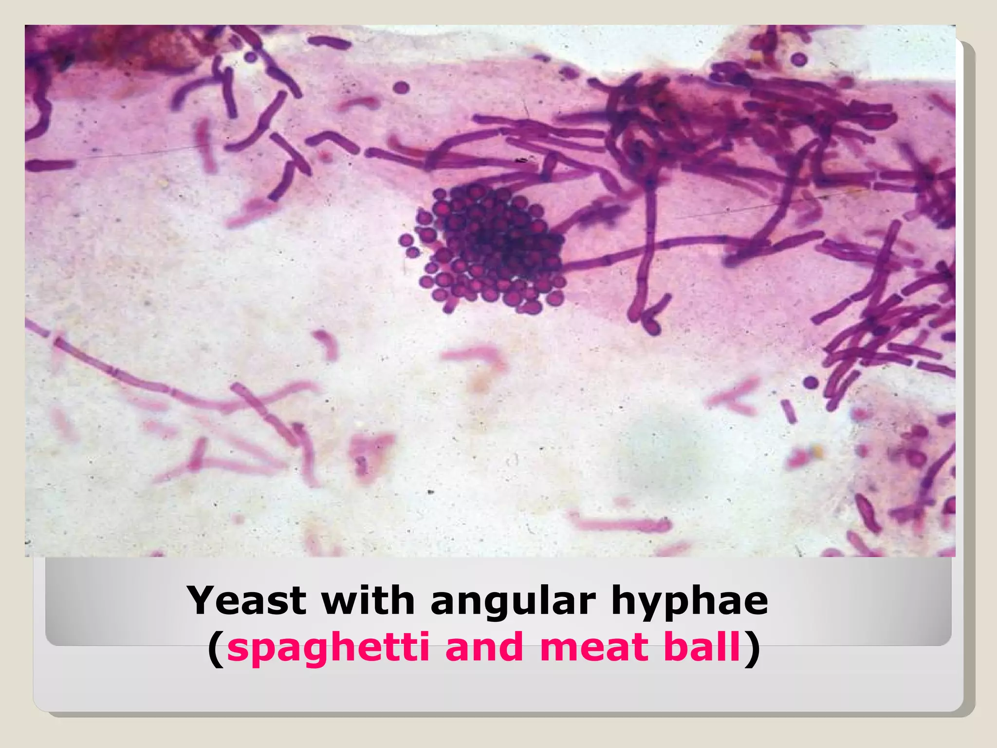 Yeast with angular hyphae
 (spaghetti and meat ball)
 