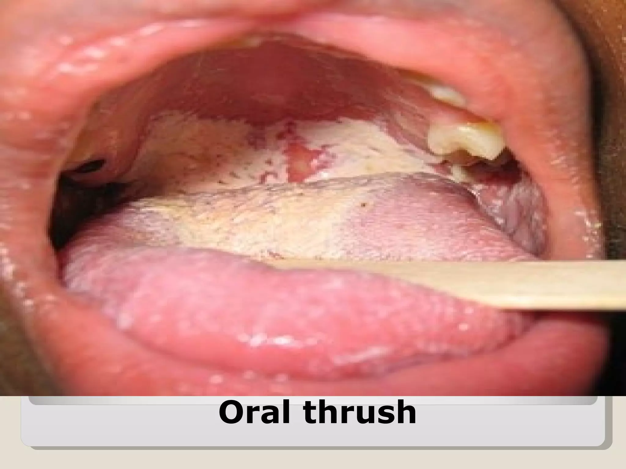 Oral thrush
 