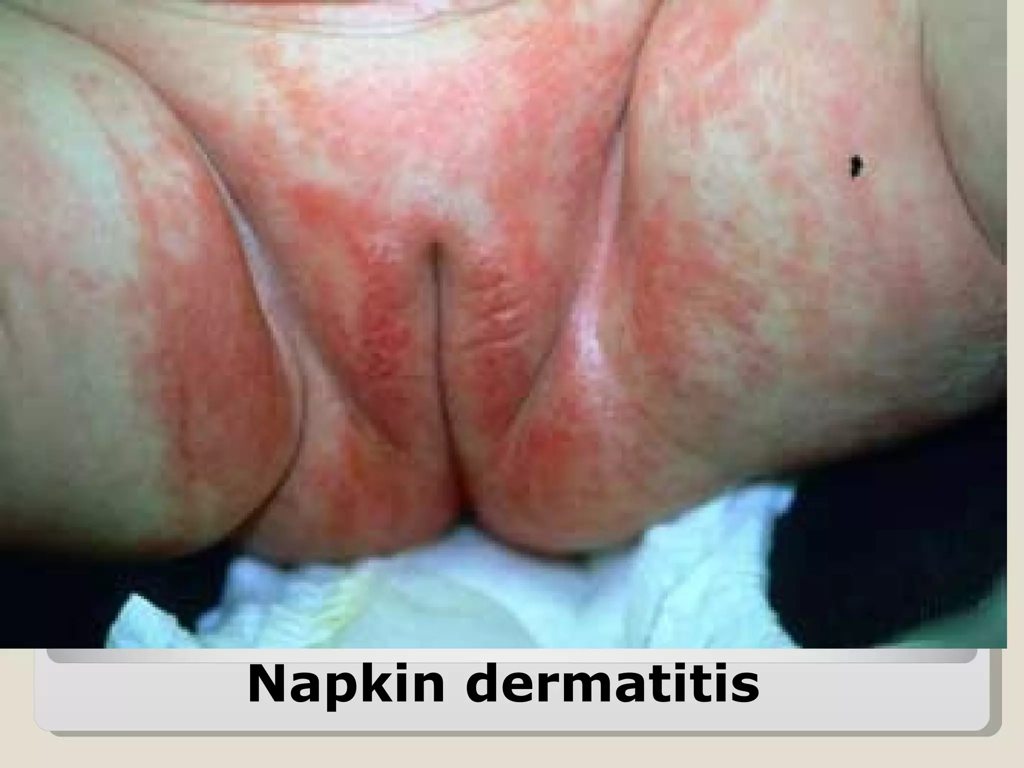 Napkin dermatitis
 