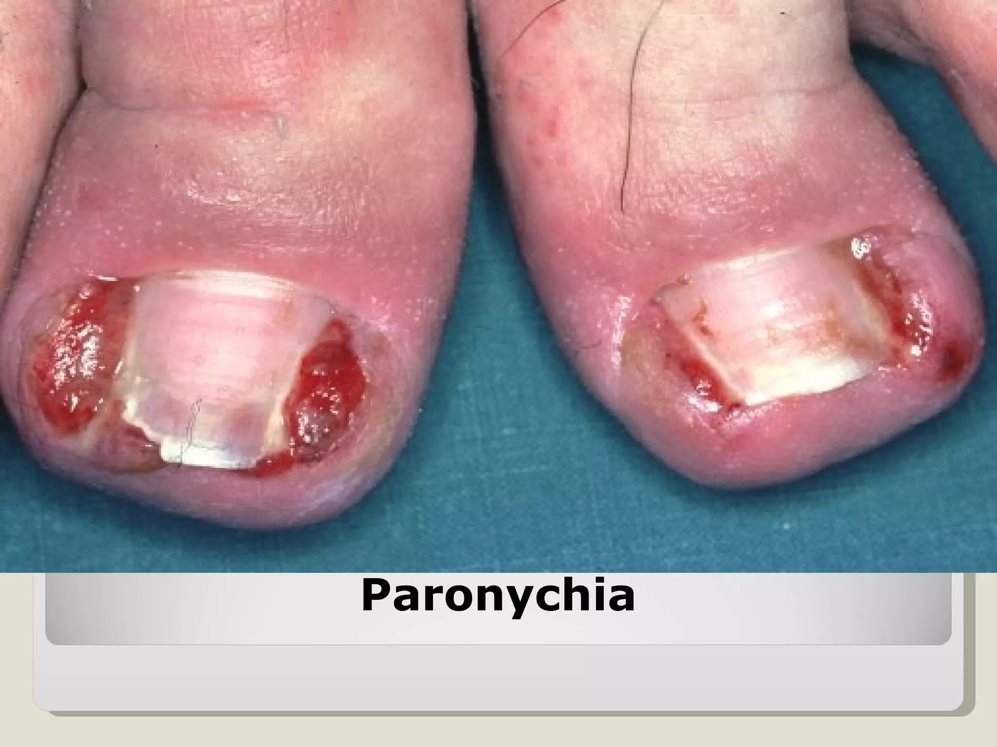 Paronychia
 