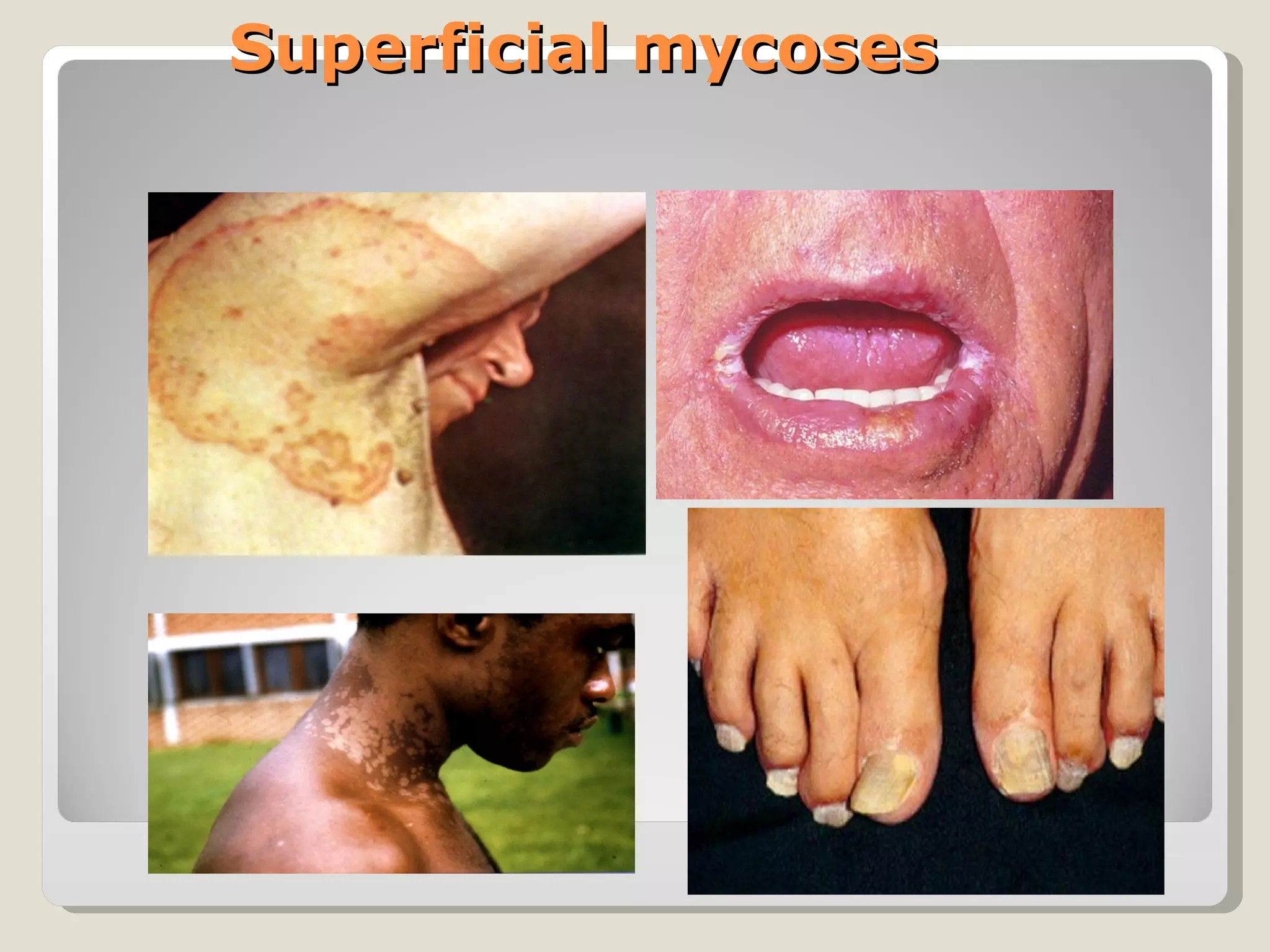 Superficial mycoses
 