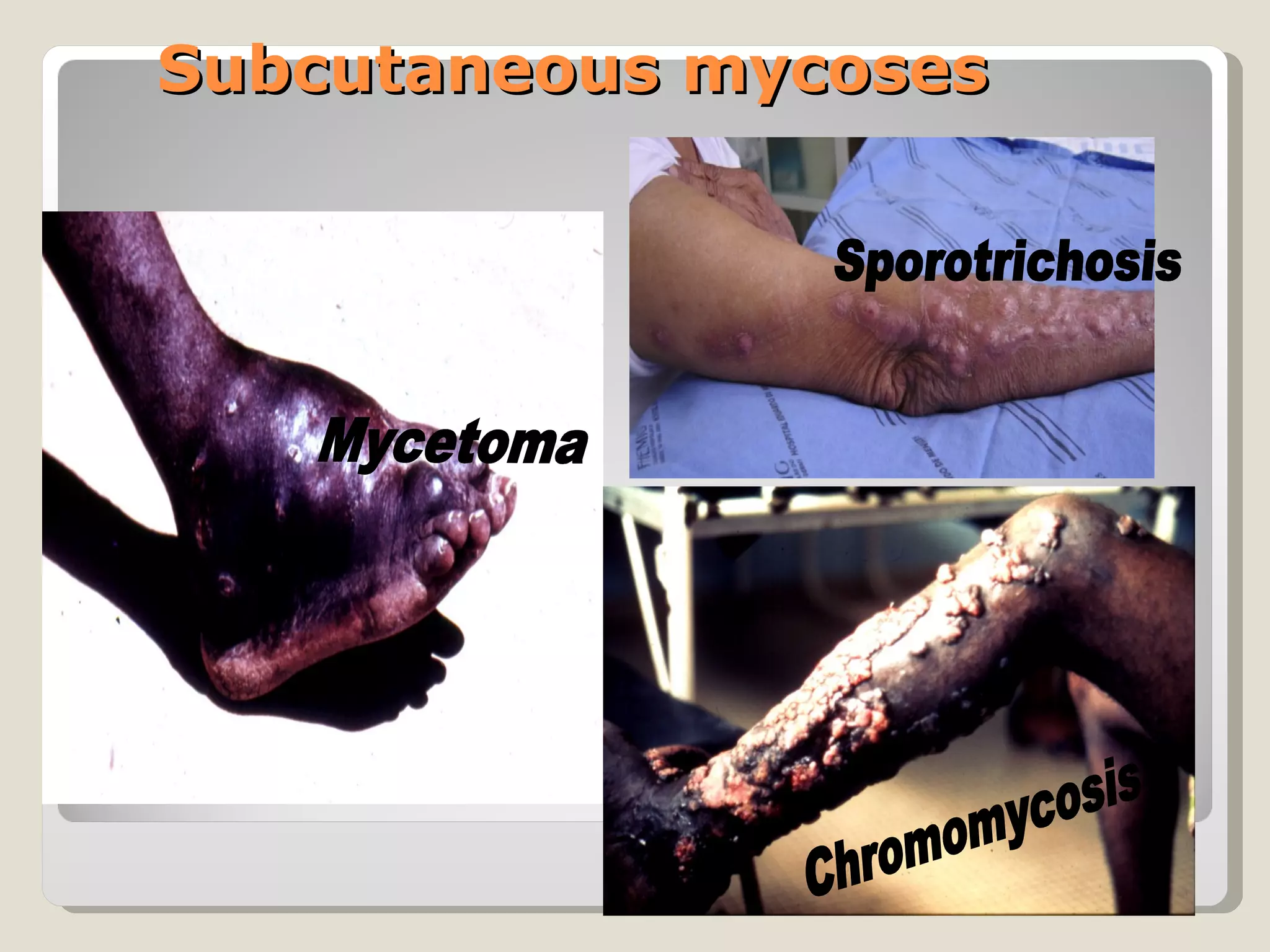 Subcutaneous mycoses
 