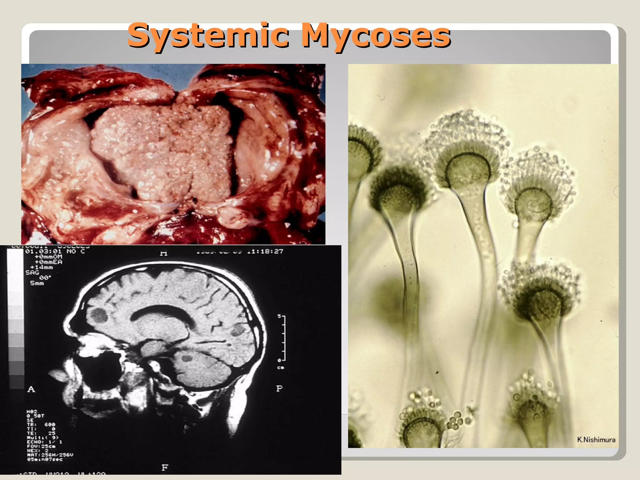 Systemic Mycoses
 