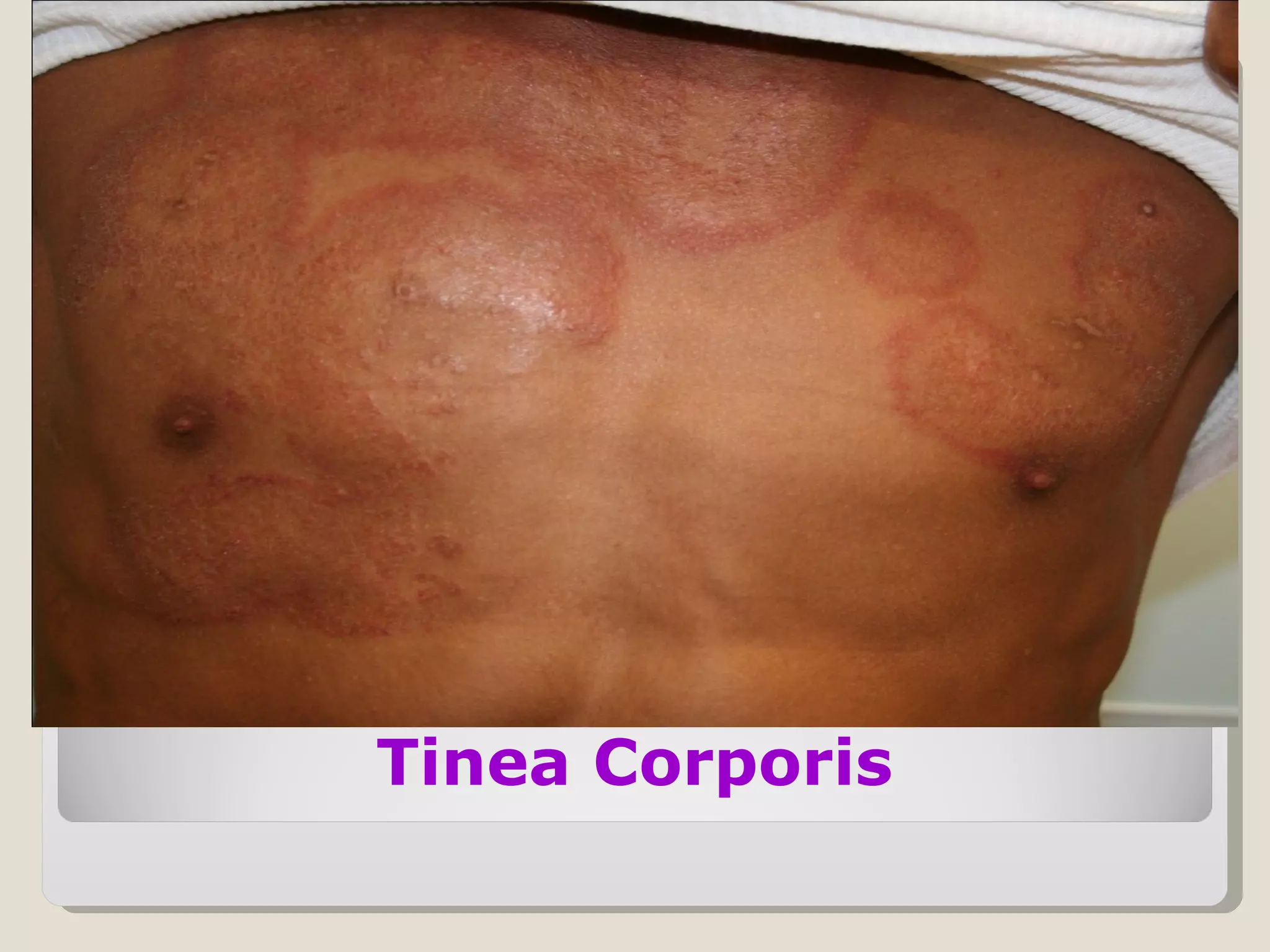 Tinea Corporis
 