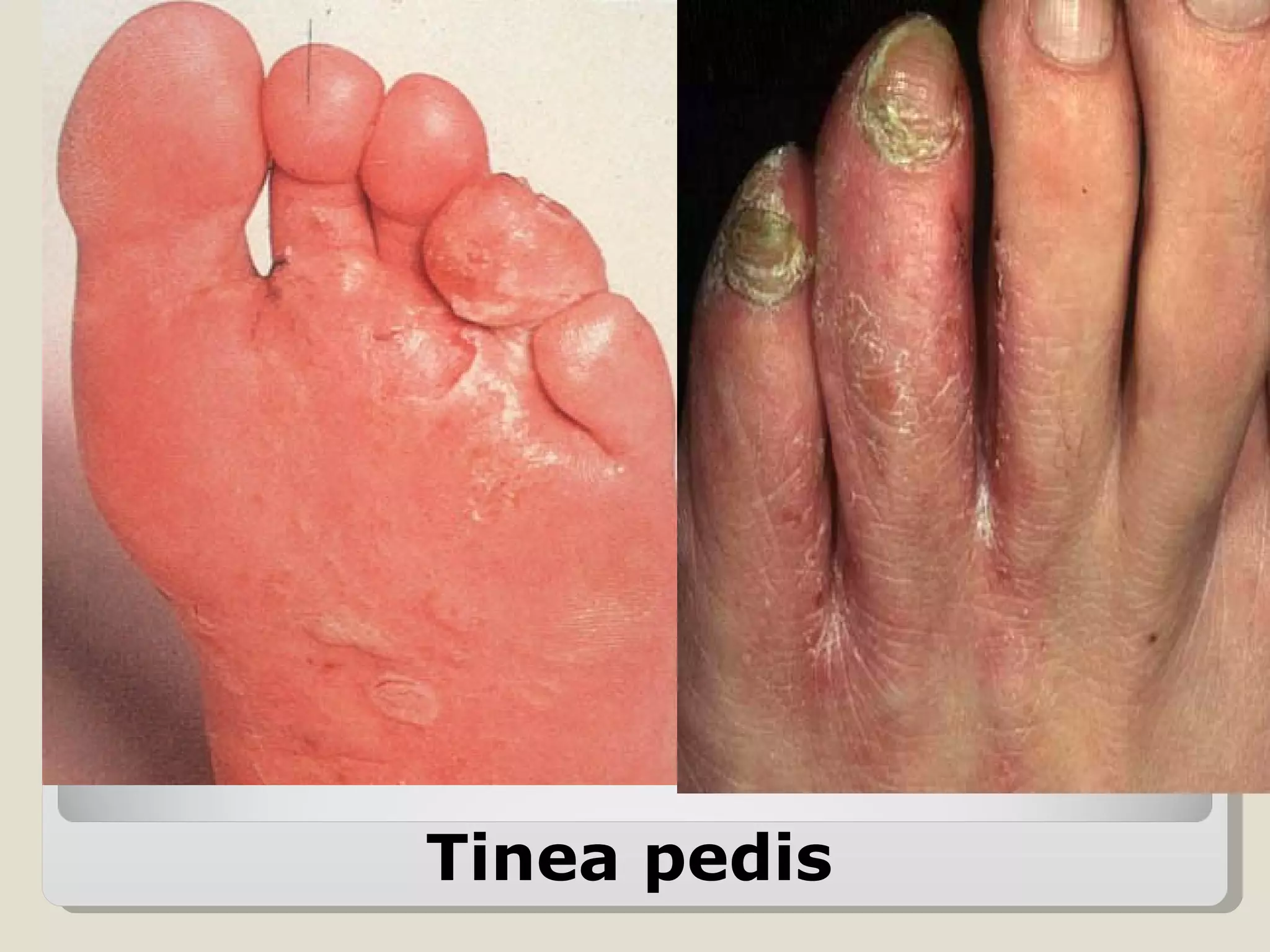 Tinea pedis
 